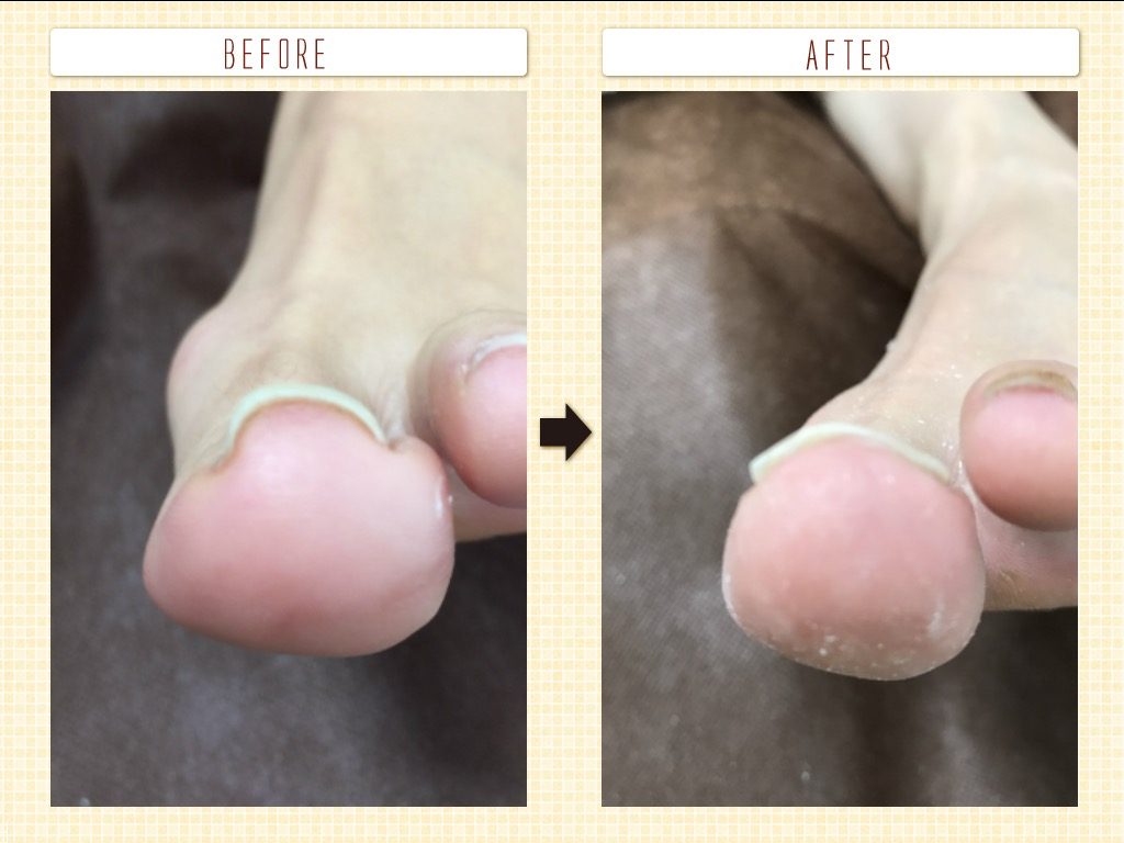 巻き爪治療画像