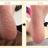 かかと足裏ささくれてガサガサ