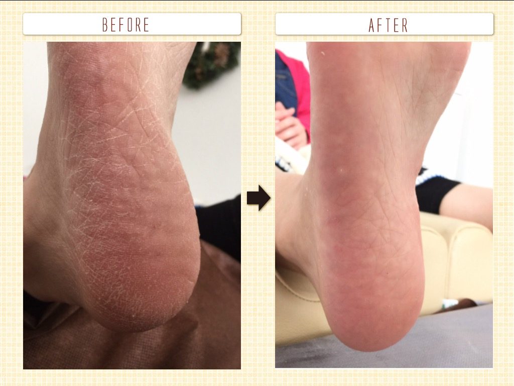 かかと足裏ささくれてガサガサ