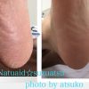 かかとが割れて痛い画像