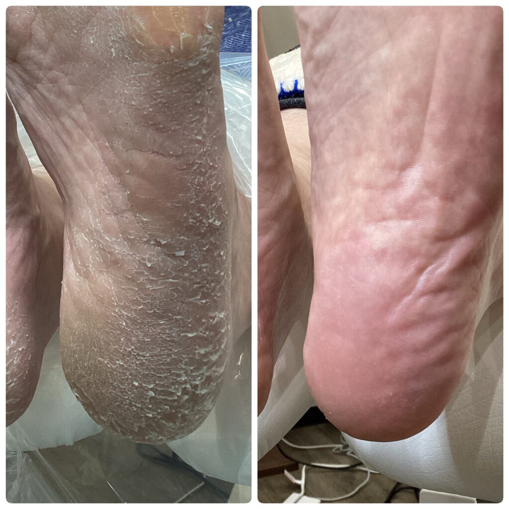 超ガサガサな角質