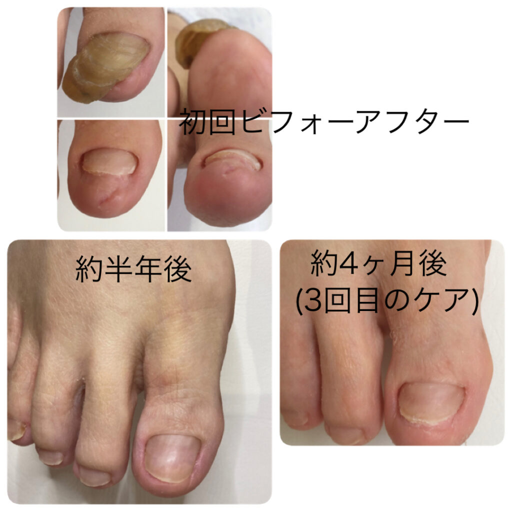 爪甲鉤弯症ビフォーアフター