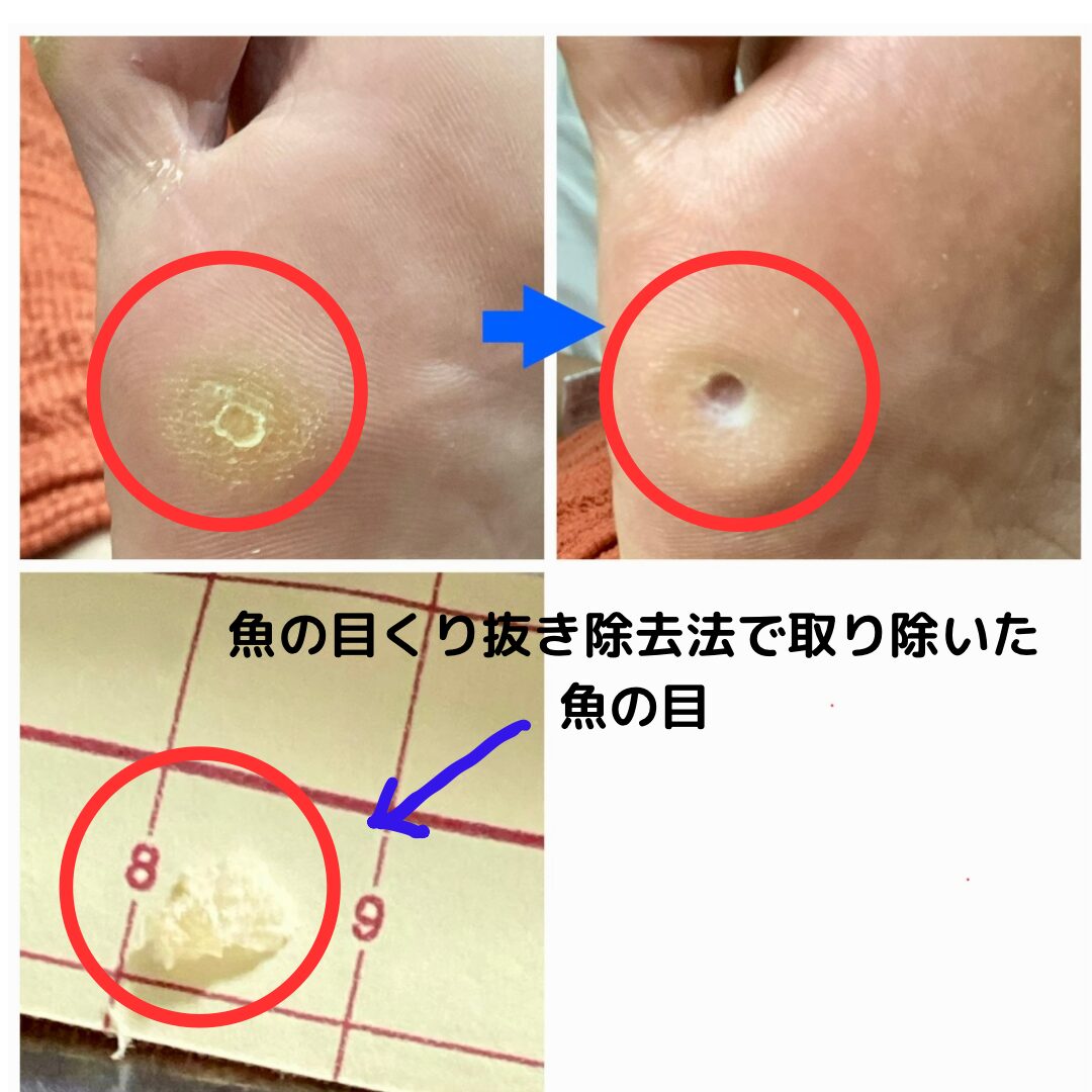 魚の目の芯をくり抜くように剥がしとるオリジナルケア。痛みはほとんどありません。そのまま普通に快適に歩いて帰れます。