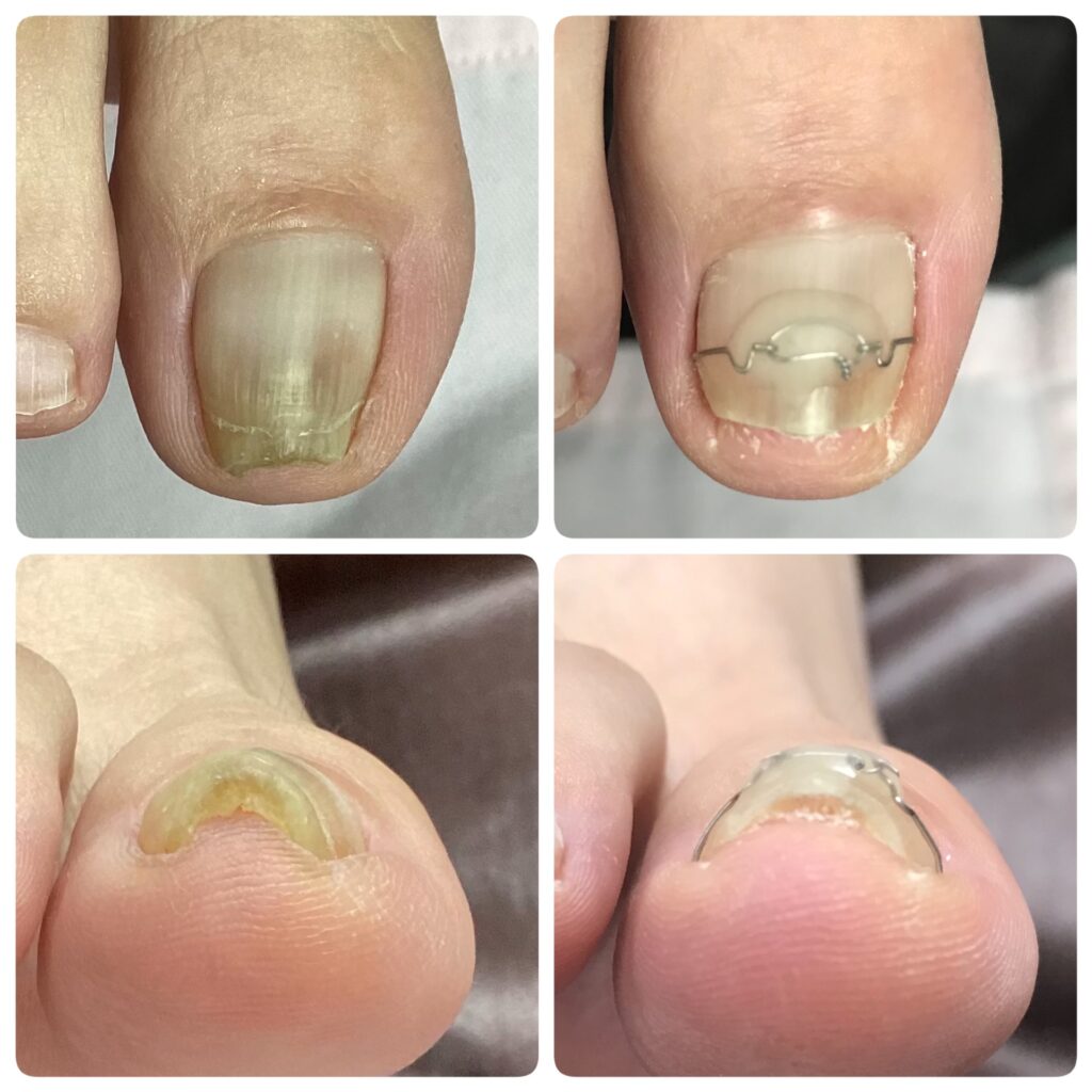 巻き爪矯正3TO(VHO)