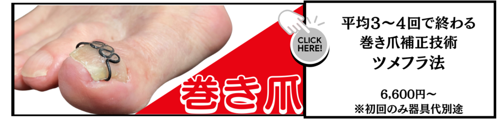 平均３〜４回、早ければ２回で補正は終了。お湯につけて爪を柔らかくし、優しく持ち上げるから一度で楽になる。